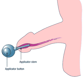 Urethral Suppositories