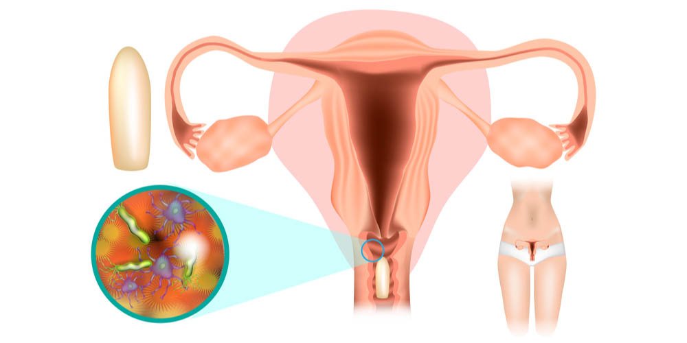 Suppository: Define in Pharmacy, Types, and Uses 3 Vaginal Suppositories
